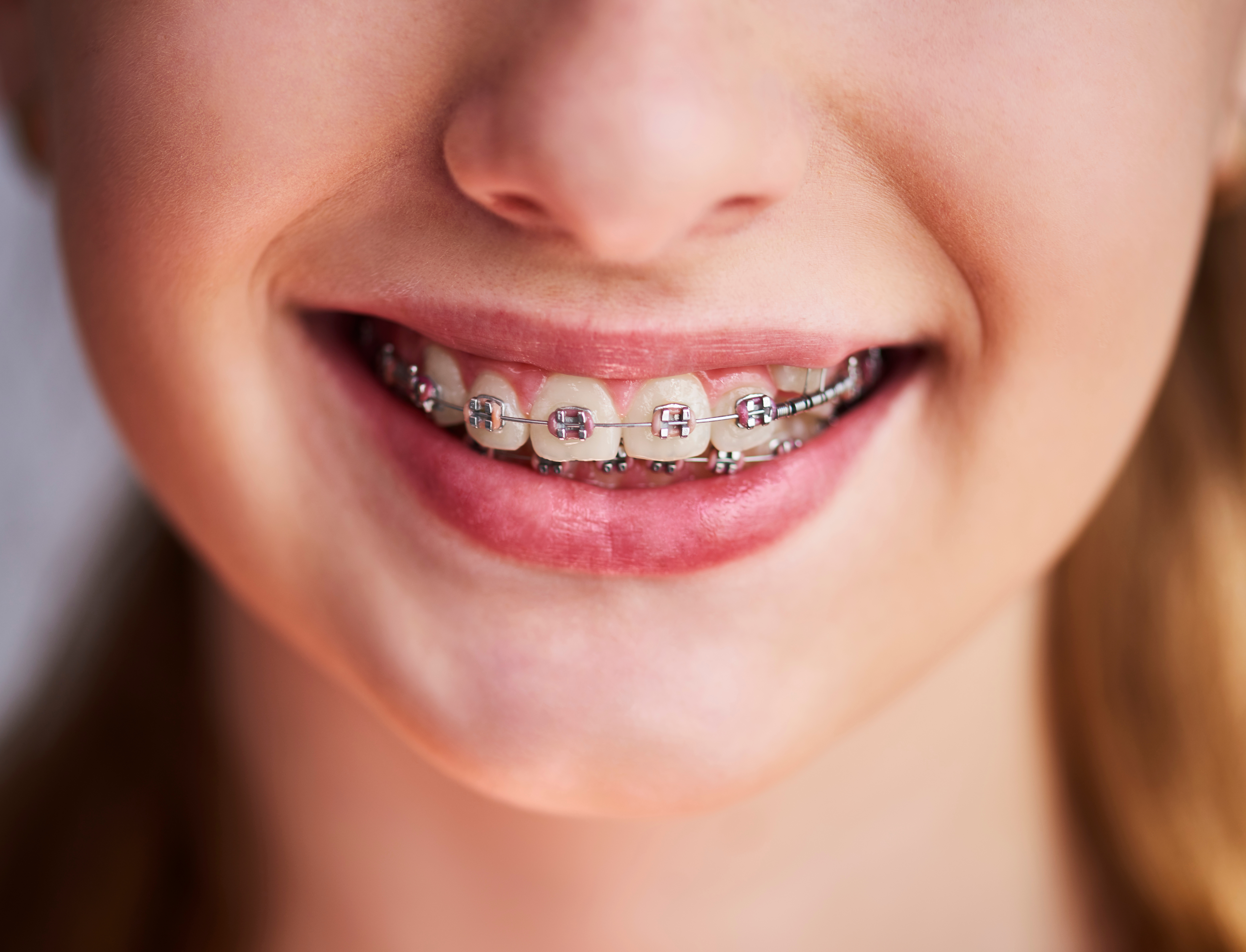 Children & Teens at NRH Orthodontics in North Richland Hills, TX