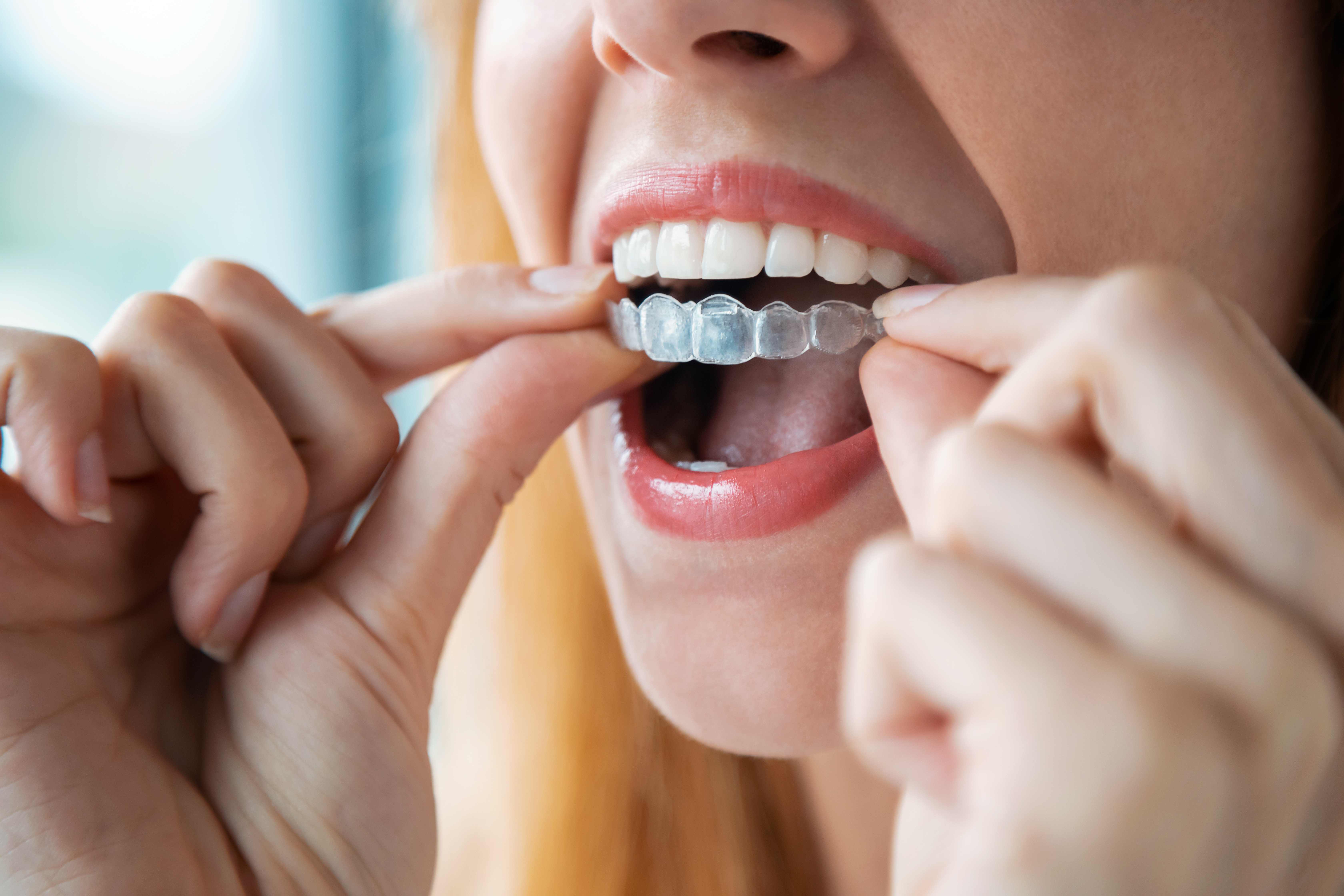 Invisalign® at NRH Orthodontics in North Richland Hills, TX
