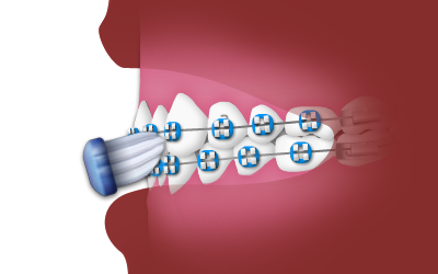 nrh-orthodontics-brush