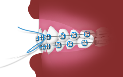 nrh-orthodontics-floss
