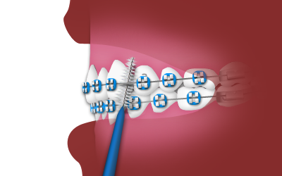 nrh-orthodontics-interdental